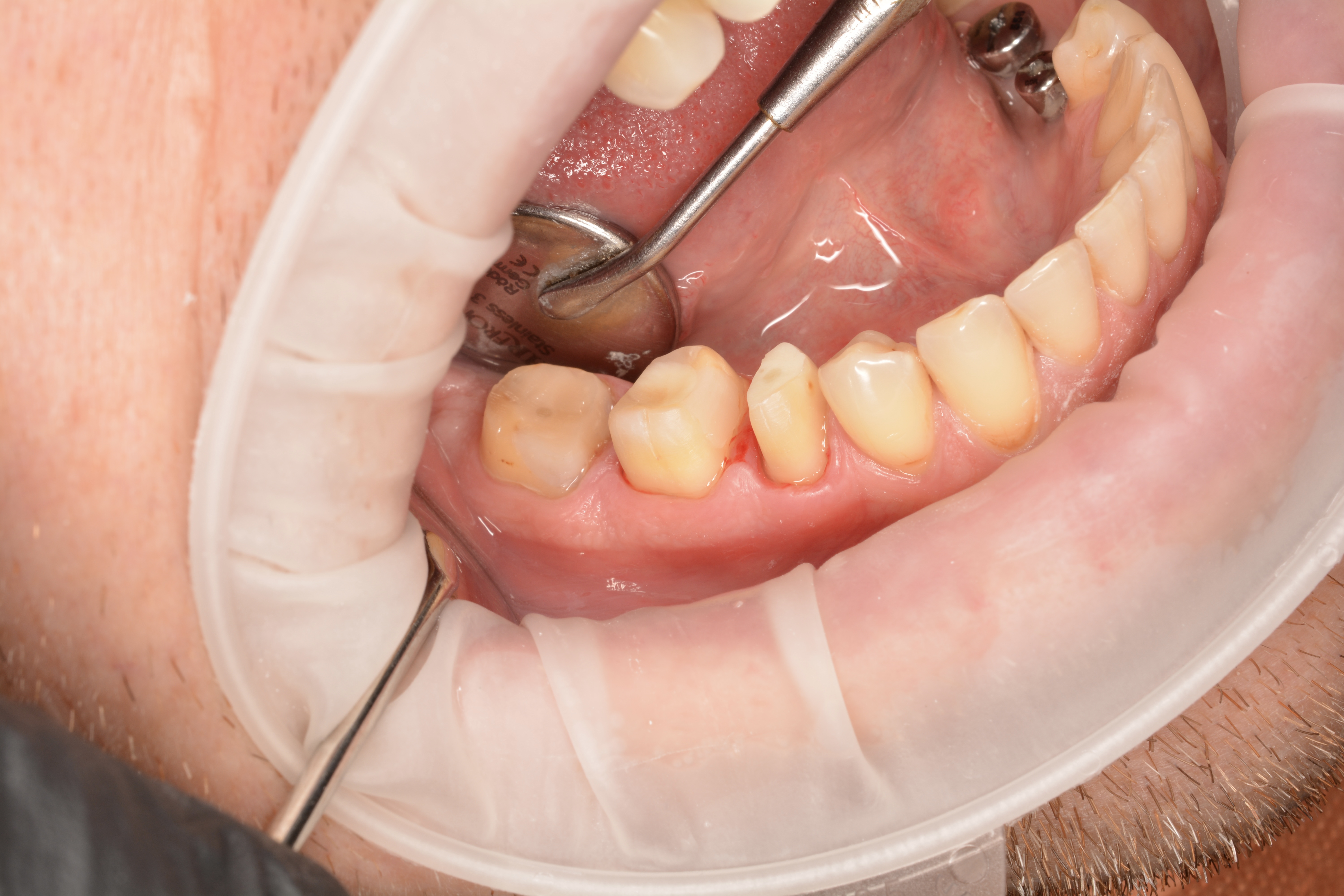 Tooth restoration with a zirconia crown — Before