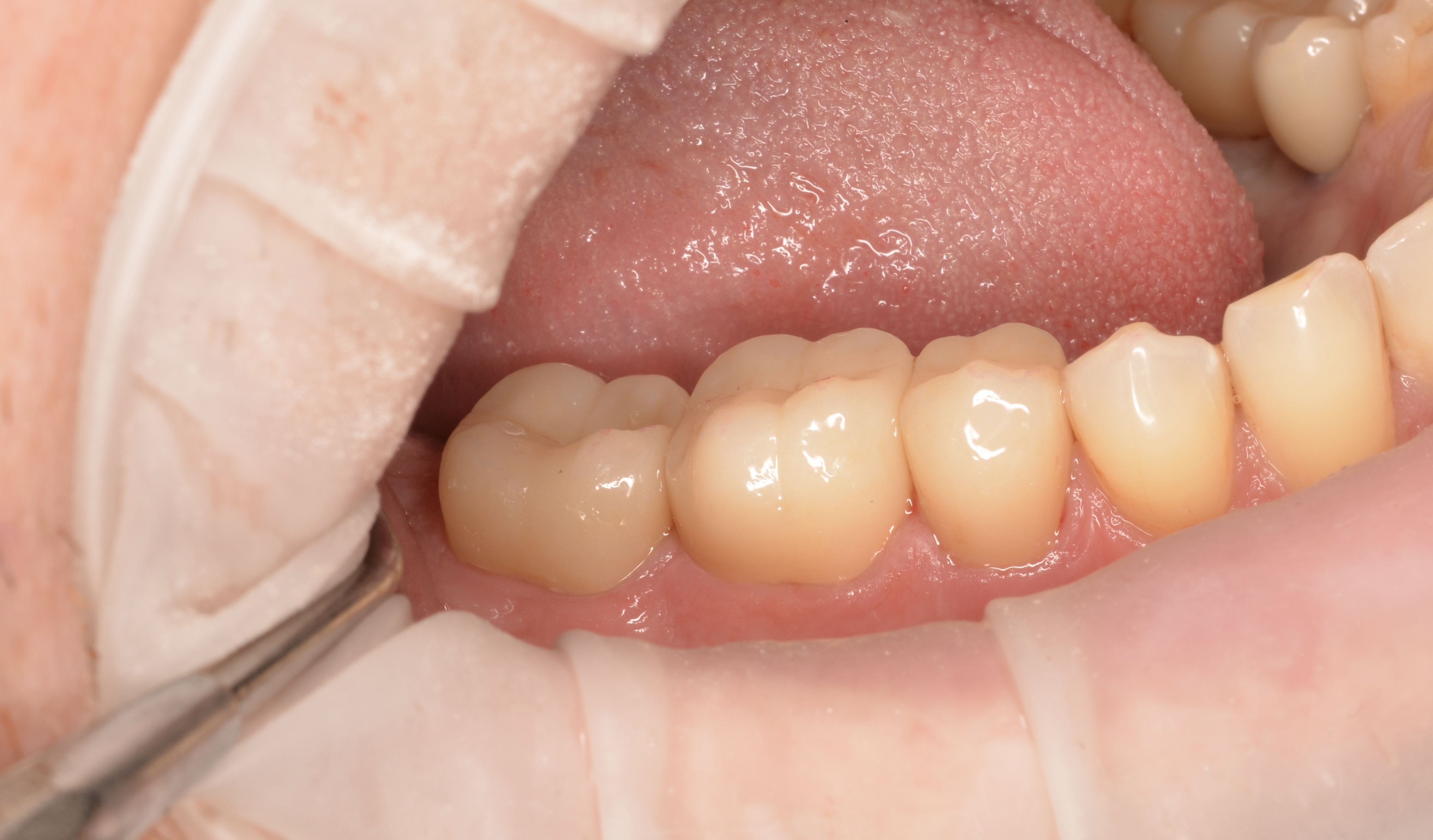 Tooth restoration with a zirconia crown — After