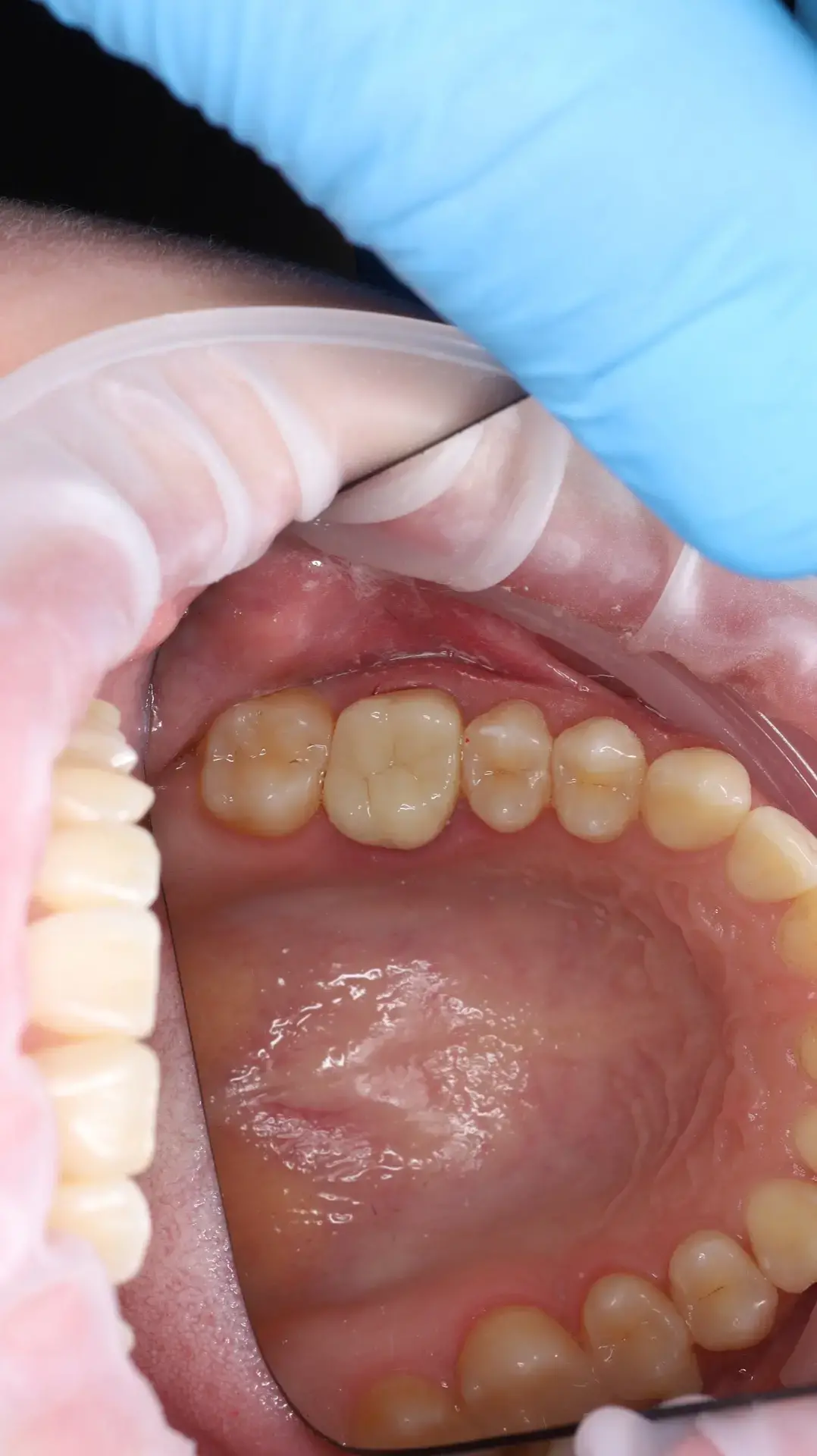 Tooth restoration with a zirconia crown — After