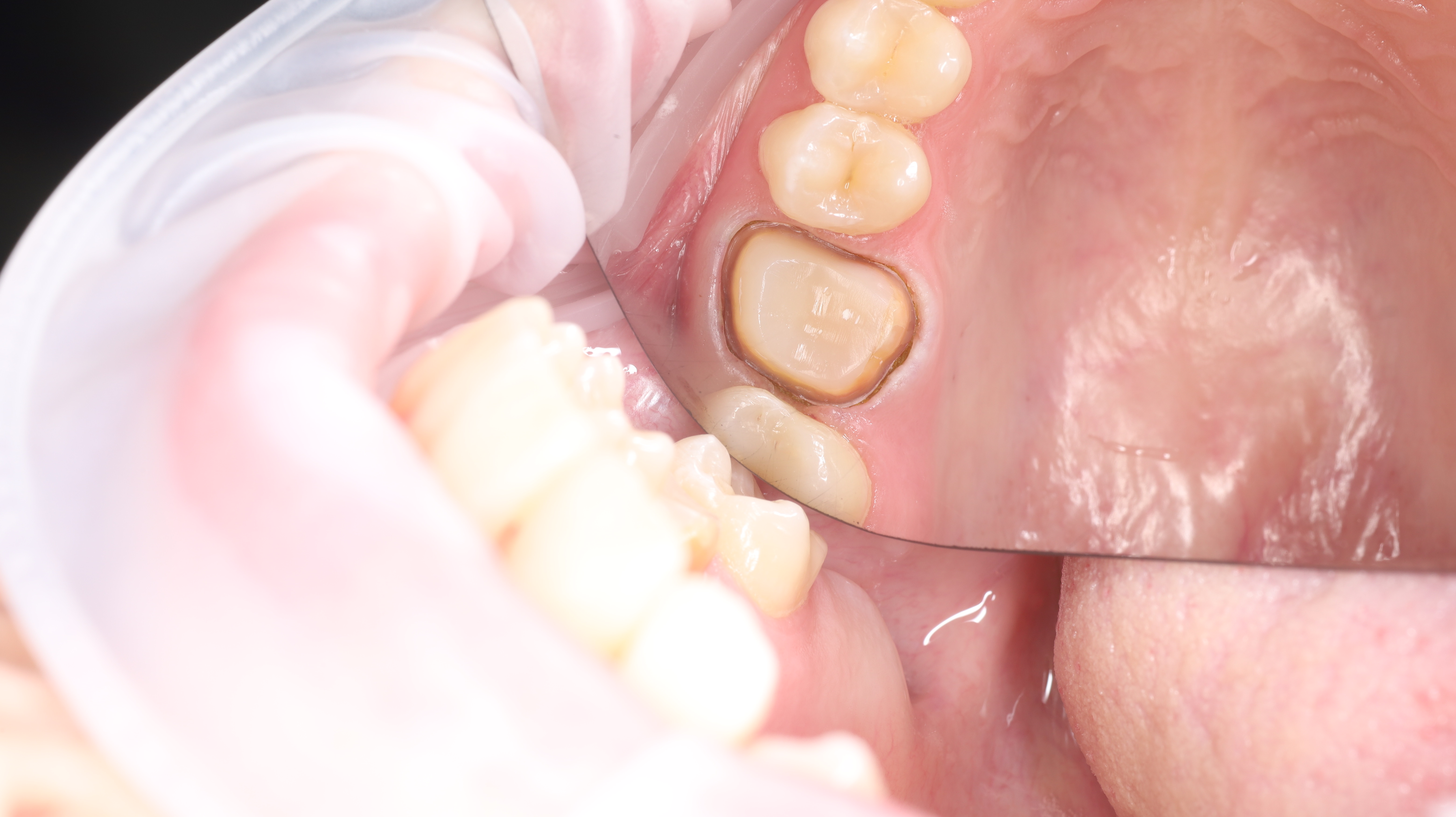 Tooth restoration with a zirconia crown — Before