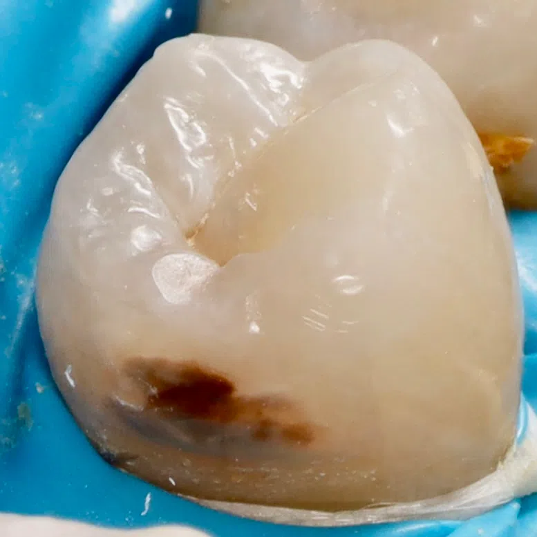 Cavity treatment on the side of a tooth — Before