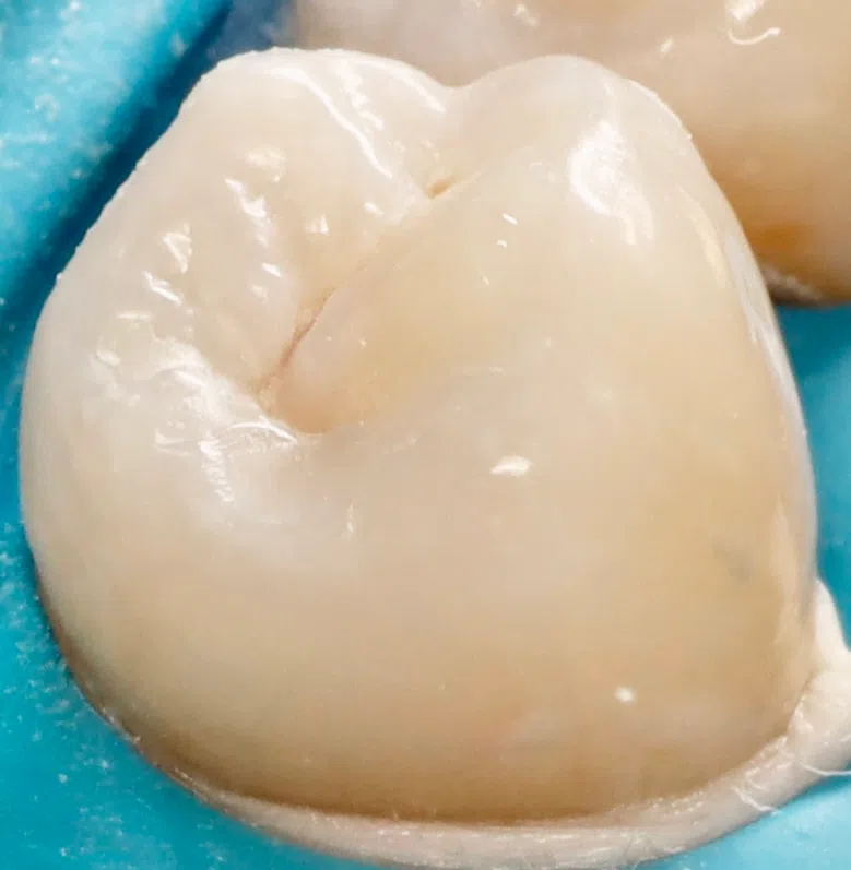Cavity treatment on the side of a tooth — After