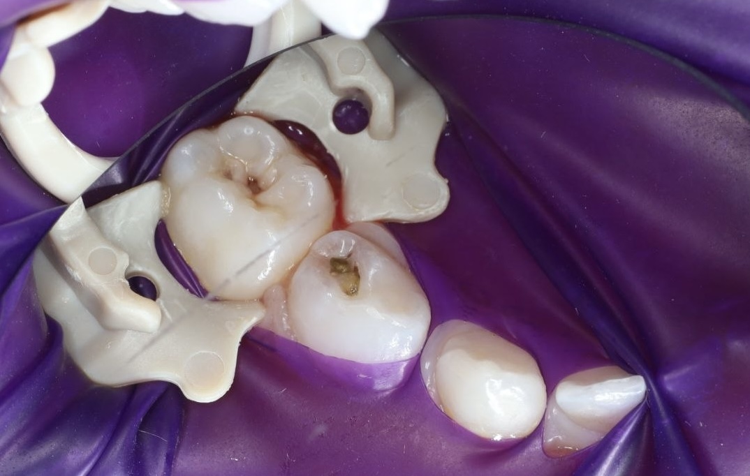 Cavity treatment — Before