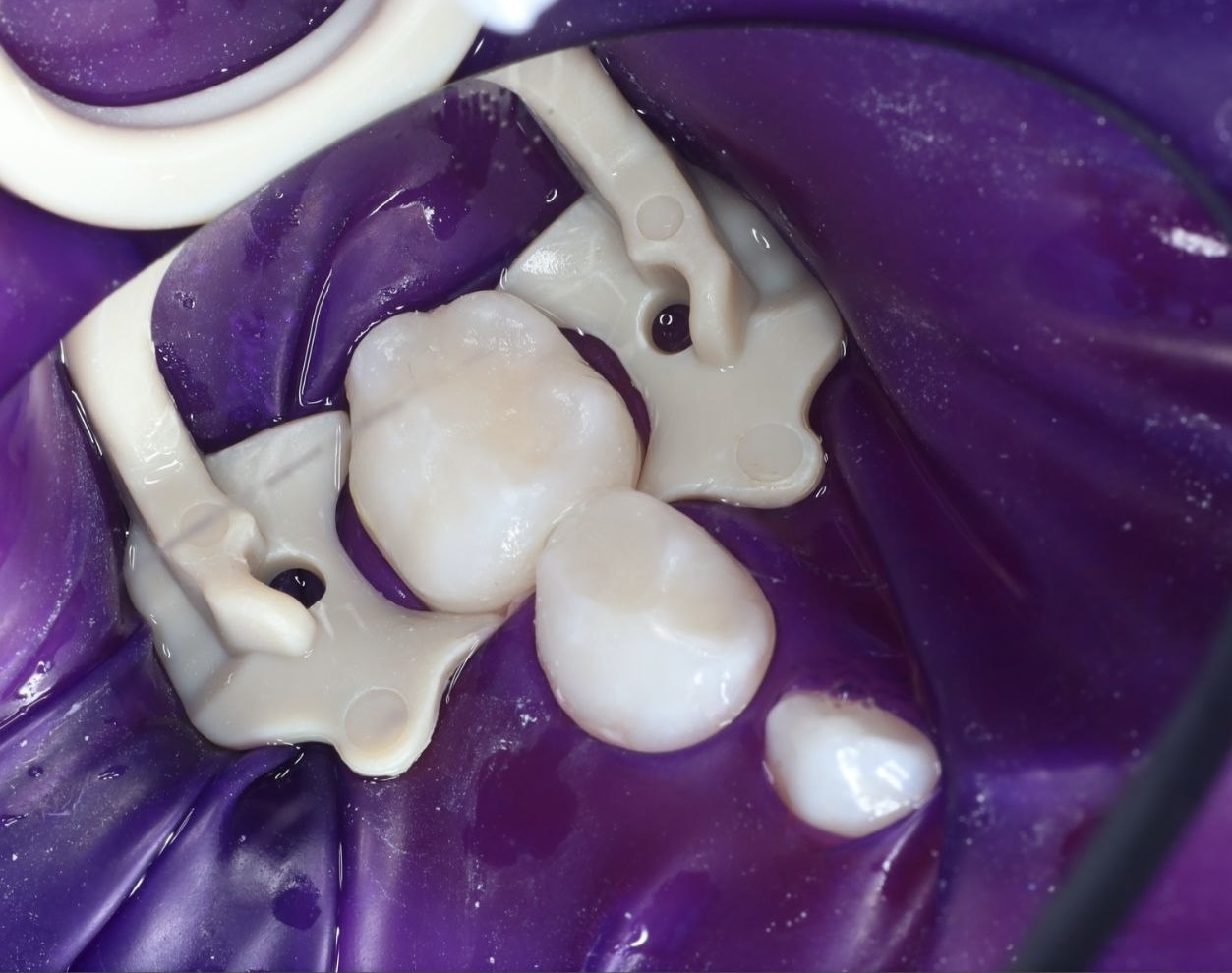 Cavity treatment — After