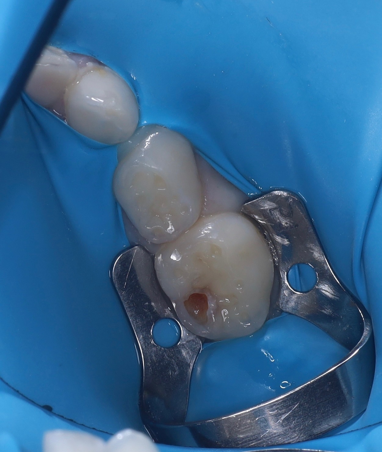Caries treatment — Before