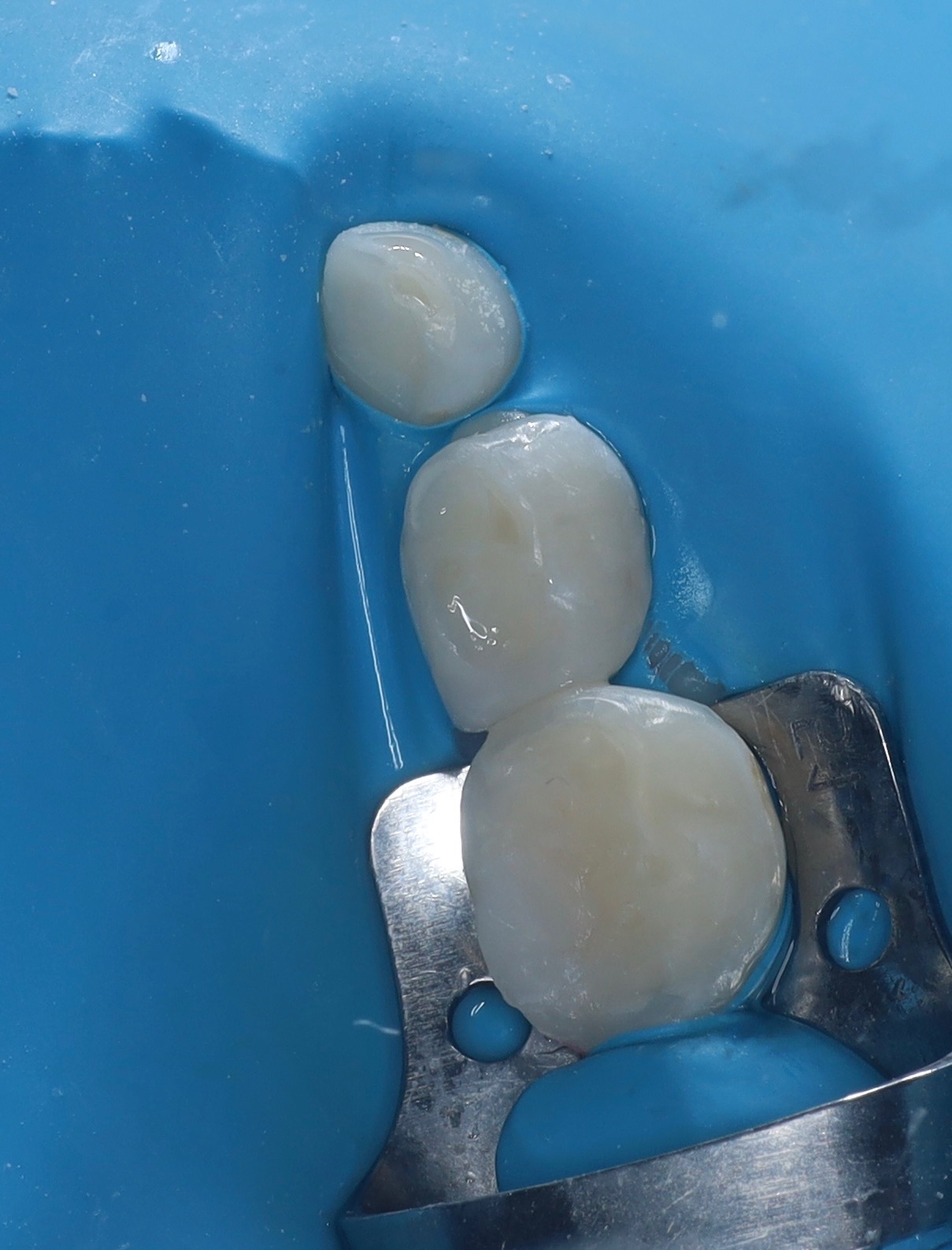 Caries treatment — After