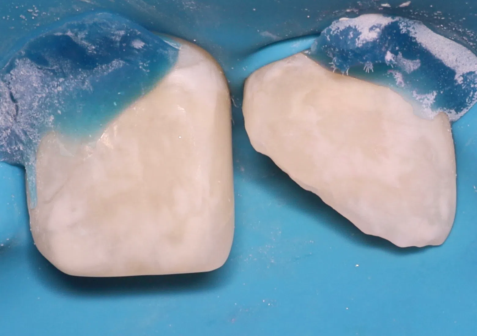 Restoring a permanent front tooth after an injury — Before