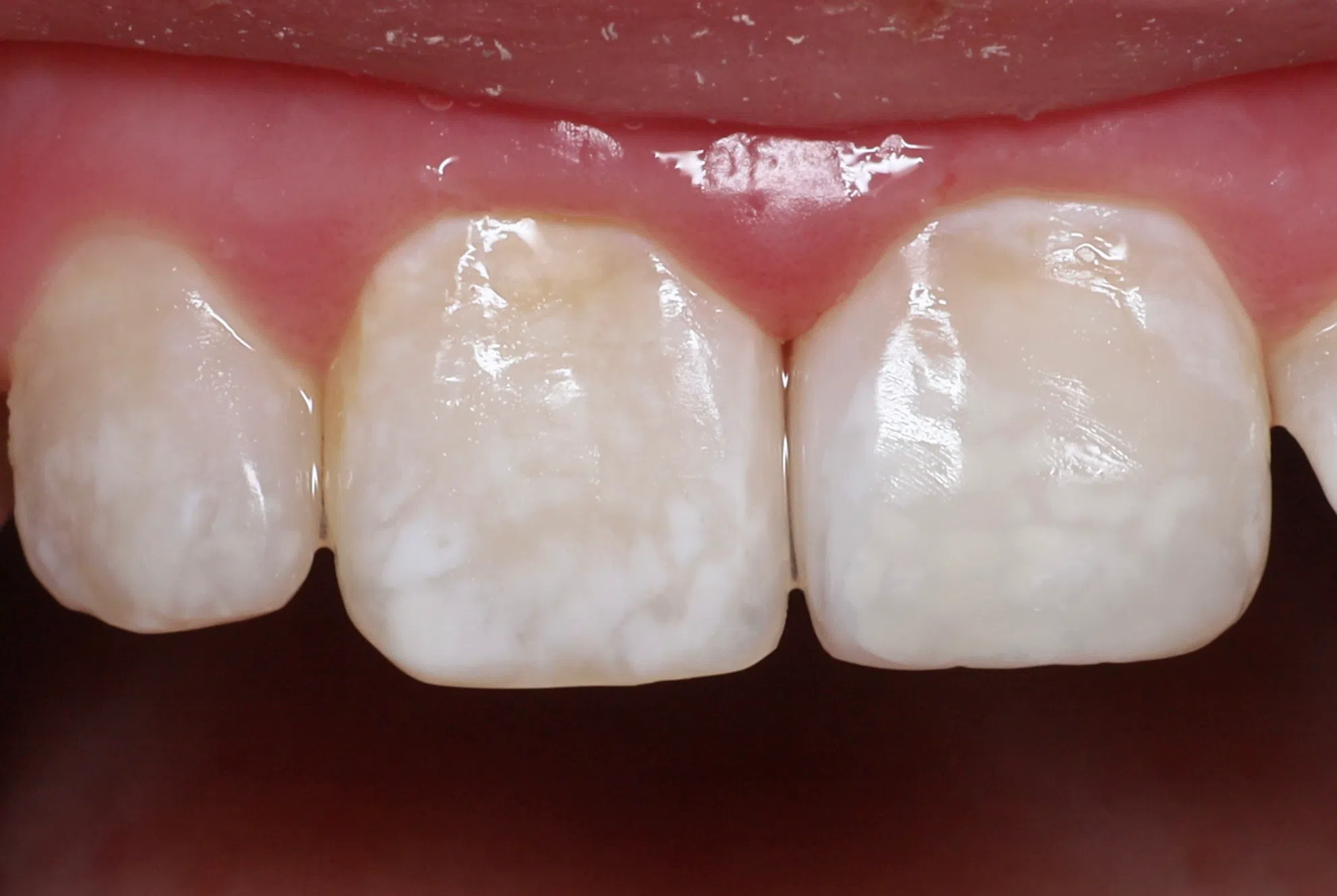 Restoring a permanent front tooth after an injury — After